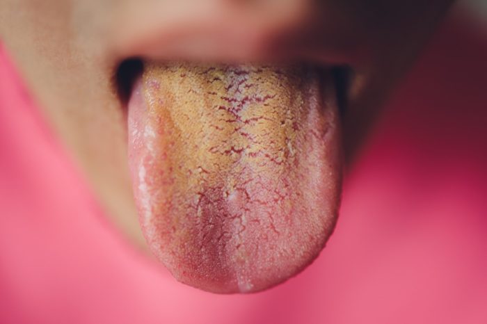 Damaged Tongue